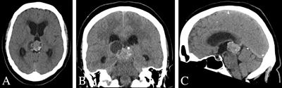 Case Report: Metastatic Bronchopulmonary Carcinoid Tumor to the Pineal Region